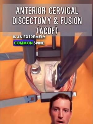 What is an #ACDF and is it a neck fusion? Texan surgeon explains  #spine #dallas #neckpain #disc