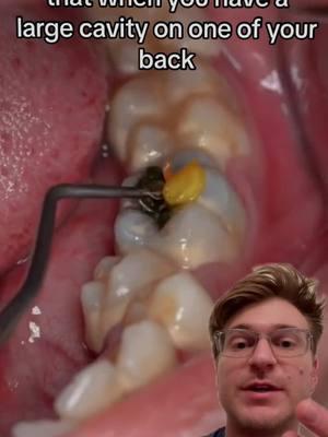 When you have a large dental filling and it breaks your tooth 😅  #dentist #teeth #braces #brokentooth #brokenteeth #dentaltips #fyp #viral 