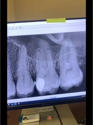 Do root canals work? YES! Root canal therapy of tooth #14 with 4 years follow up. #endodontics #endodontist #dentistry #dentist #dentists #dentistryschool #dentalschool #dentalhygienist #dentalassistant #toothache #tooth #teeth #rootcanal #rootcanaltherapy 