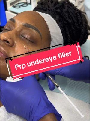 Under-eye PRP for natural rejuvenation! ✨ Conservative approach > fillers for this case 👁️ #PRPBeauty #UnderEyeTreatment #NaturalAesthetics #StratfordConnecticut #CTVibes #CTLife#connecticut 