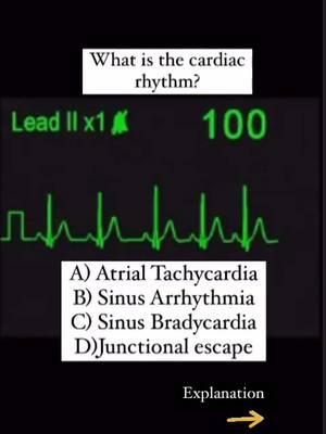 What is the cardiac rhythm?  A) Atrial Tachycardia  B) Sinus Arrhythmia  C) Sinus Bradycardia  D) Junctional Escape  #ekg #ecg #tachycardia #tampamedical 