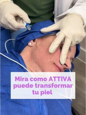 Attiva es una tecnología de radiofrecuencia subdérmica que trabaja desde el interior de la piel para estimular colágeno y elastina, logrando un efecto tensor y reafirmante duradero. Se puede realizar en varias partes del cuerpo como: ✅ Brazos: Ideal para tratar la flacidez y mejorar la firmeza de la piel, especialmente en la cara interna, donde la pérdida de tonicidad es más notoria. ✅ Cuello: Reafirma y mejora la textura de la piel, reduciendo la laxitud y las arrugas que aparecen con el paso del tiempo. ✅ Mejillas: Ayuda a redefinir el contorno facial, mejorando la flacidez y aportando un efecto lifting sin necesidad de cirugía. ✅ Papada: Reduce la flacidez y el exceso de piel en la zona submentoniana, logrando un perfil más definido y juvenil. Attiva, es la solución perfecta para quienes buscan resultados naturales, progresivos y sin tiempos de recuperación prolongados. ¡Dale un boost a tu piel con esta tecnología innovadora! 😍 ¿Aún tienes dudas? Déjala en los comentarios 👇🏻👇🏻 #chinitasbydailyn #miamilakes #fillers #estética #attiva #attivatreatment 