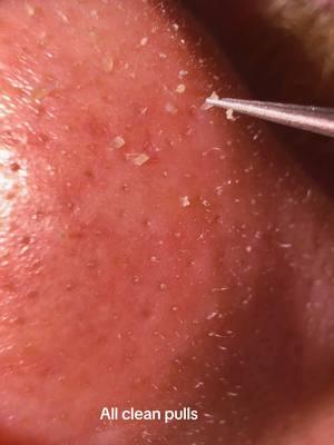 Satisfying sebaceous filament removals. #skin #skincare #pimplepopping #pimples #sebaceousfilament 