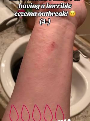 Eczema & Rh- Blood 🩸 Anyone else? #rhnegatives #rhnegativesuperpowers #fyp #rhnegativesecrets #rhesusfactor #rhnegativefactor #blood #rhesusnegativeblood #anegative #bnegative #abnegative #onegative #bloodtype #oneg #abneg #bneg #aneg #rhnegativeblood #rhnegativo #rhnegativetribe #rhnegativelife #rhnegative #rhnegativeblood #rhneg #rhnegativebloodtype #rhnegativelife #rhnegativebasques #rhnegativefemale #rhnegativepregnancy #pregnancy #rhesusnegatif #rhesusnegativ #rhesusnegativeblood #rhesusnegativemother #rhesusnegativemaman #rhnegativemomma #rhnegativemale #rhnegativefemale #rhnegativefamily #rhnegativepregnancy #rhnegatives ##rhnegativeseed #rhnegativeshaman #rhnegatives #childbirth #rhnegativechild #rhesusnegativeblood 