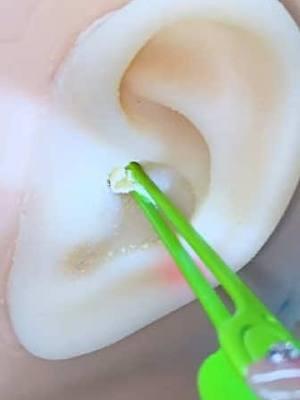 La cuchara de excavación de orejas con cámara puede ver claramente todos los rincones de la oreja, puede experimentar la diversión de cavar orejas en casa, tanto para adultos como para niños.#TikTokShop #tiktok  #earwaxremoval #earwax #satisfyingvideo #oddlysatisfying #gross #pimplepopper #family #christmas #TikTokShop #fyp#earpick    #TikTokShopLoveAtFirstFind  #spotlightfinds  