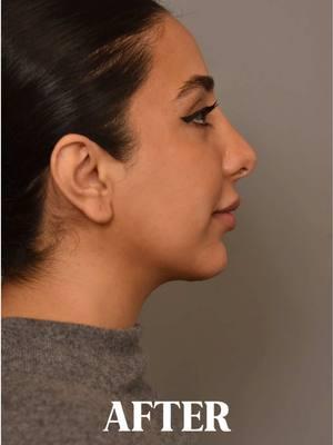 Can you guess what procedures I performed on this patient? Hint - there are two!  If you guessed Neck/ Chin Lipo AND Chin Implant… you are correct!!  This patient came to me unhappy with the fullness under her chin, so I performed a little liposuction and put in a chin implant to give her a better jawline.  #neckliposuction #chinimplant #lipo #implant #jawline #CapCut 