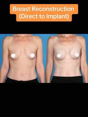 This patient had a direct to implant breast reconstruction with 345 cc M profile implants. *this patient was kind enough to share her photos and story, she is not asking for your opinion about her body, be respectful in your comments #plasticsurgerybeforeandafter #beforeandafter #breastcancer #brca #breastreconstruction  