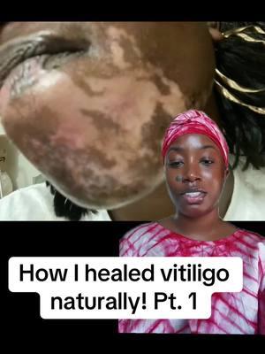 How I healed vitiligo naturally! It was a long journey but let’s get into it!! #vitiligo #homeopathic #homeopathicmedicine #healing #fyp #westernmeds