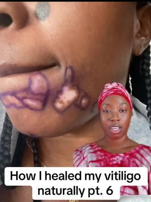 How I healed my vitiligo naturally! pt. 6 #vitiligo #homeopathic #homeopathicmedicine #healing #fyp #westernmeds 