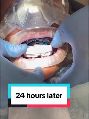 One of the first videos we ever posted. #allon4 #zygomaticimplant #zygomaticimplantsurgeon #allonx #allon6 #allon6zygoma #teethin24texas #teethin24hours #teethinaday 