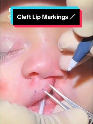 Hi 👋🏼 everyone!  It’s #markingsmonday!! 🖊️🖊️ Today I’m highlighting the intra-op markings of a recent LEFT unilateral  COMPLETE cleft lip 👄 and nasal 👃🏼 reconstruction.  It is important to keep in mind that EVERY cleft patient has unique anatomy. Therefore my markings 🖊️ for each repair are different in each case, which ultimately leads to  a unique surgery each and every time. 👍🏻 Stay tuned for updates on this baby’s progress! I hope this video was helpful! As always, leave your questions and comments below. 👇🏼 Goal: To help make children WITH clefts look like children WITHOUT clefts. 😄 Mission: Transforming children’s lives one smile at a time. 👍🏼 These images are the property of Dr. Rachel A. Ruotolo and NYPSG and are not authorized for use by any other party. This is my actual patient with real results who has given informed consent (directly or indirectly via parents) to appear on my website and social media pages. #makingsmiles #cleftliprepair #cleftpalate #cleftlip #cleft 