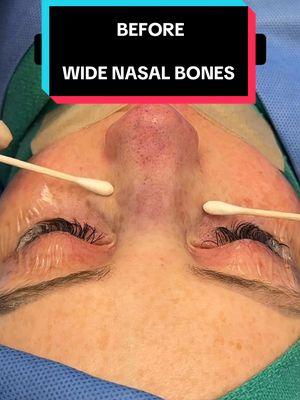 Nasal Bone Contouring with Endonasal Scarless Nose®️ Rhinoplasty.  Permanently Contoured forever.  For immediate assistance, visit: https://www.scarlessnose.com/contact and our concierge team will respond promptly!  Ready to book a consultation? Visit https://www.scarlessnose.com to schedule a virtual or in-person consultation.  At Beverly Hills Rhinoplasty Center, Dr. Dugar exclusively performs Closed Scarless Nose® Rhinoplasty as 100% of his surgical practice! 📞 Call/Text (USA): (424) 722-3484 🌍 International (WhatsApp): (+1-310-276-1703) #nosejob #rhinoplasty #scarlessnose #closedrhinoplasty #bestrhinoplastysurgeon #scarlessrhinoplasty #bestrhinoplasty #scarlessnosejob #bestnosejob #bestplasticsurgeon #drdugar #fyp