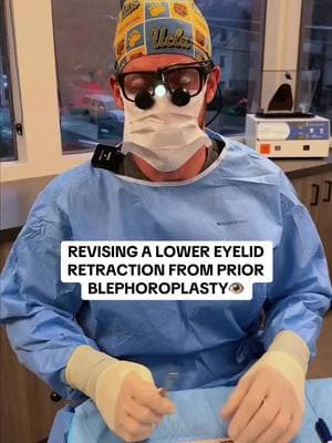 Lower eyelid retraction (pulling down) is a near devastating consequence of old-school, transcutaneous lower eyelid blepharoplasty (lower lid surgery with an incision through the skin and muscle).* Retraction is defined as a pulling down of the lower eyelid margin position. Some of the time, it is subtle, so much so that the patient often does not notice it until it is pointed out to them. In these cases, it is often just a shape change at the outside corner, which we call a lateral bowing. In some situations, retraction is more significant, and the lid margin is pulled down enough that you can see white (scleral show) below the colored portion of the iris. 👁️ This is where things get serious, as it can lead to issues with exposure of the cornea/eyelid surface and very poor aesthetics. Lower lid retraction dramatically changes the look and character of the eye. This character change is the most disturbing aspect for many patients, as they quite literally do not recognize themselves when they look in the mirror anymore.  This was the case with our 33 year-old(!) patient who came to see me from a highly populated part of the country after having prior upper and lower eyelid procedures (amongst other procedures) with this devastating consequence. Because of her age and the strong emotional response and identity crisis that she was up against, I took a very complex, intricate, and multifaceted approach to correct or lower eyelid retraction SCARLESSLY! I did not want to add any more incisions to her lower eyelid than she already had, which would have been the easier and more standard approach.  The portion you see here is one of the most unique - borrowing extra mucosal lining from the roof of her mouth (hard palate) to utilize on the backside of her eyelid as a spacer to create extra mucosa there, replacing the conjunctiva. *Because of this strong propensity for a transcutaneous lower blepharoplasty approach to lead to this retraction issue, I exponentially prefer a transconjunctival, or scarless approach to the lower lids. #drchesnut #lowerlidretraction #enigmalift