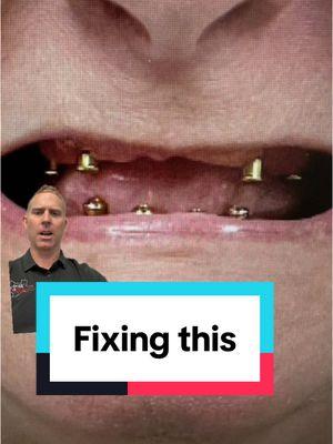 From snap in denture to fixed implant teeth #zygomaticimplant #allon4 #allon6 #allonx #teethin24hrs #teethin24texas #teethinaday #minidentalimplants #snapindentures #dentures 