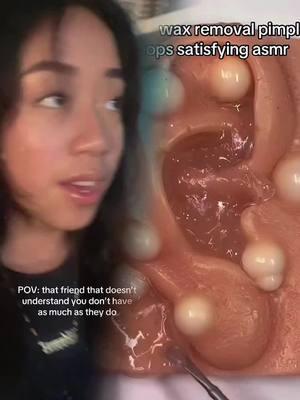 #earwaxcleaning #earwax #earwremoval #ears #blackhea #pimple #blackhead #pimple #foryou #earwaxremoval #earwax #earcleaning #earwaxirrigation #satisfyingvideo#cleanears #fypage #fypシ゚ #fypツ #foryou #funny #skit #comedy #pov #fyp #foryou