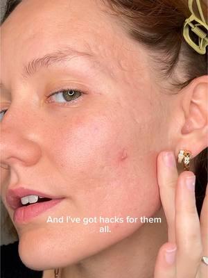 Ac-ne, Back-ne, Chest-ne -- I've struggled with breakouts and tried hundreds of solutions. @OXY Canada works for every kind of Ne. Please use as directed. #Acne #AcneProblems #AcneJourney #AcneCare #AcneAwareness #ClearSkinJourney #Breakout #AcneTreatment #AcneSkincare #AcneTips #AcneCure #AcneFighter #AcneSolutions #AcneControl #AcneFree #AcneRemedies #HormonalAcne #CysticAcne #AdultAcne #TeenAcne #AcneScars #SkincareRoutine #SkinCareCommunity #SkinCareTips #SkinCareAddict #BeautyBlogger #SkinPositivity #LoveYourSkin #RealSkin #ConfidenceOverAcne