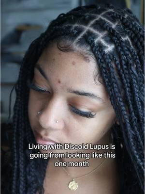 Currenr situation… Praying for healing !  🗣️Join my Living with Lupus Support Group where we’ve been discussing medication, remedies, doctors, trauma experiences, vulnerable pictures, and more 💬 Creating this safe space was the best decision ( 🔗linked in my bio) #livingwithlupus #lupusawareness #hairloss #fyp #autoimmunedisease #lupusawareness #lupuswarrior🦋💜 #lupusstruggles #lupusmom #lupusstruggles #autoimmunehealing #chronicillness #chronicillnessawareness