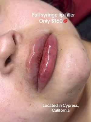 Link in bio to book ! 💋  #lipfiller #lips #russianlips #buenapark #anahiem #fypシ #fullsyringe #1ml #orangecounty #losangeles 