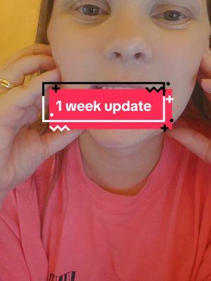 1 week update ❤️❤️ they're so beautiful #dentalimplants #allon4 #trending #myjourney #ourstory #mystory #ectodermaldysplasia #geneticdisorder #awareness #educating #allon6 #procedure #surgery #update #weeklyupdate #fullmouthrestoration #smilemakeover 