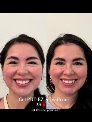 I was not prepared for these results!! 🗣️ injectables dont have to make you look fake #prfezgel #prp #prptreatment #nurseinjector #aestheticnurse #botox @SAGE AESTHETIC WELLNESS 🤍🩺 