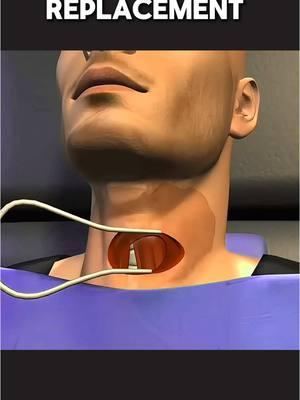 Cervical Disc Replacement Surgery (3D Animation) #cervicaldiskreplacement #discreplacement #discreplacementsurgery #cervicaldiscreplacementsurgery #dissectomy #discreplacements #herniateddisc #spinalcordsurgery #medical3danimation #3dmedicalanimation #totaldiscreplacement 