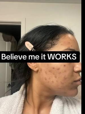 I have to put YALL on … I literally never had #acne #problem nor #hyperpigmentation before & had no clue how to fix it .. I tried everything !!!! Please believe me it works just stay consistent!!!! Day and night !!! Give yourself a real face routine!! #skin #hyperpigmentation #confidence #solution #consistency #koreanskincare #journey #women #happy #itreallyworks #girl #skincare #routine #skincareroutine #darkspots 