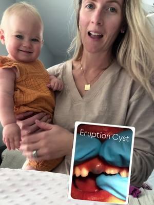 Eruption Cyst on my baby’s gumline  #baby #babyteeth #teething #parenting