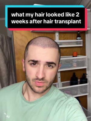 found this cool draft from 2 weeks after my hair transplant in Turkey, the healing process is so fascinating, can’t wait to finish the job and get my 2nd transplant this year! #hair #hairloss #hairgrowth #hairprogress #haircare #hairline #recededhairline #regrowth #bald #balding #thinning #thinhair #thick #full #products #medication #treatment #finasteride #minoxidil #scalpmassager #rosemaryoil #dermaroller #xyon #xyonpartner #growplex #aimike #rogaine #keeps #hims #propecia #kirkland #topical #foam #liquid #oral #pill #journey #transformation #daily #series #day180 #tutorial #stepbystep #routine #regimen #results #proof #beforeandafter #slowlybutsurely #trusttheprocess #followalong #explanation #education #explained #DHT #hairfollicles #baldspot #howto #consistency #everyday #nevergiveup #positivity #motivation #hairtok #fyp #viral #xybca #chris #zeph #ibby #freddy #turkey #vitamins #biotin #hairtransplant #grafts #donorarea #complex10 #suppliment #prescription #hairfibers #hairfiller #fibers #veraclinic #mane #maneexlirblend #maneoils #maneoilblend #price #turkey #istanbul #medicatedlotion #lightlytap 