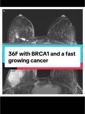 This was 100% preventable. Why is it so hard to get doctors to listen to women?  #brca1 #breastcancer #newmexico #womenshealth 