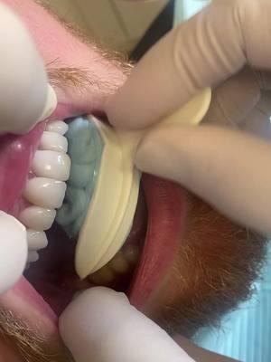 Temporizing a tooth! #emax #dental #dentist #dentistry #beauty 