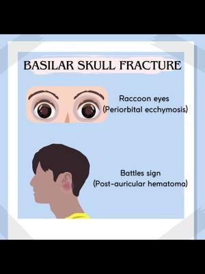 B A S I L A R   S K U L L    F R A C T U R E S 🦴🩺⚕️ This is a traumatic head injury that involves the break of one or multiple bones at the base of the skull. How to diagnose? • Physical exam • Neurological exam • Glasgow coma scale  • CT scan  SIGNS Include but are not limited to otorrhagia(bleeding from ears), Raccoon eyes, Battles sign, halo sign. #battlessign #raccooneyes #basilarskullfracture #hematoma #beckstriad #jugularvendistension #medsurg #cardiology #anatomystudy #physiology #stem #paschool #medschool #nursingschool #paramedicschool #emtschool #studytips #studymotivation #nurse #paramedic #emt #doctor #medicalstudent #ems #surgery #nursing #fyp #healthcare #medical