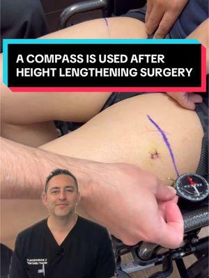 Our Height Lengthening patients have gained a magnetic personality 🤣 #tiktok #LearnOnTikTok #viral #height #taller #tall #shortking #orthopedicsurgeon #compass #surgeonsoftiktok #surgeon #doctorsoftiktok #fyp #foryou #doctors #shortman #heightdifference #heightproblems #viralvideo 