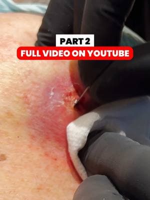 #pimplepopper #pimplepopping #thedoc #thedoctok #drmudgil 