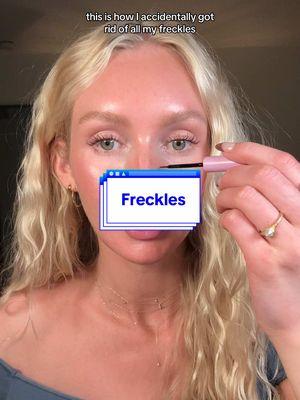 Oopsies? I miss them kinda…  #sunscreen #hyperpigmentation #freckles #fakefreckles #glowyskin #glassskinroutine #skintransformation #acneproneskin #clearskin #dermatology #skincancer #sundamage #antiaging 