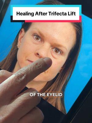 Trifecta Lift = lower blepharoplasty + fat transfer to mid-face + skin tightening. (Not all patients get a skin pinch and not all patients get co2 laser. The skin tightening portion is customized based on each patient’s needs). 📍Beverly Hills, CA. #eyes #eyebags #trifectalift #darkcircles #kamiparsamd #blepharoplasty 