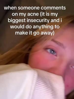 People making fun of acne HURTS but we’re better than bullying back ❤️👏🏼 credits to @maddi_g23 #acne #skincare #acnetreatment #pimples #skinpositivity #acnepositivity #skincareaddict #teamacne