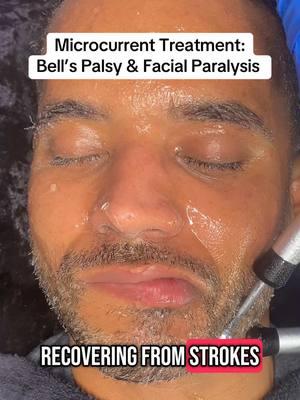 Microcurrent For Bell’s Palsy & Facial Paralysis Treatment. #BellsPalsy #LosAngelesEsthetician #Skincare #PhysicalTherapy #Stroke #strokeawareness 