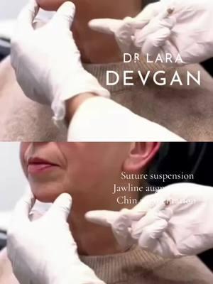 A nonsurgical approach to the lower third of the face: suture suspension, jawline augmentation, and chin augmentation.  A nonsurgical approach to enhancing the lower third of the face with advanced techniques including suture suspension, jawline augmentation, and chin augmentation to achieve a more defined and youthful appearance without the need for invasive procedures.  Suture suspension provides immediate lifting and support to sagging tissues, improving jawline definition and reducing jowling with minimal downtime. Jawline augmentation helps restore lost volume, enhance contour, and create a sharper, more structured profile by strategically placing fillers along the mandible. Similarly, chin augmentation can improve facial balance and proportion, addressing concerns such as a weak or recessed chin.  These minimally invasive techniques offer a customizable and beautiful solution for individuals seeking to refine their lower facial aesthetics, with results that can be tailored to enhance natural features while maintaining a subtle, harmonious look.  #beautyisinthedetails #devganoptimization #facialoptimization #boardcertifiedplasticsurgeon 