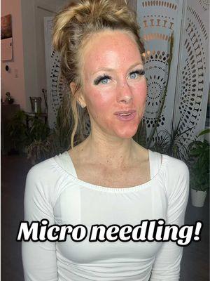 Post micro needling… #vampirefacial #microneedling 