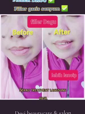 #padahariini #fillerdagu #filler #fyppppppppppppppppppppppp #promoperawatanhongkong #viral #promoperawatanwajah #hongkong #devibeautycare_123 #devi_beautycare_salon #perawatankecantikan #fyp #perawatankecantikanhongkong #fillerhongkong #fillergarissenyum #fillergarissenyumhongkong 