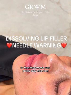 WARNING: needles  . dissolving my migrated lip filler🙌🏼 #dissolve #dissolvingfiller #fillermigration #migratedfiller #lipinjections #injections #dissolvinglips #fy 