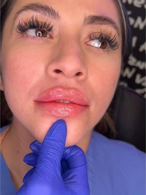 Aumento de labios natural y definido ✨💋 #labios #aumentodelabio #rellenosfaciales #vanessa_injects #vanessainjects #houstonaesthetics #botoxhouston #lipfiller #houstoninjector #miamifillers #houstoncosmetics #juvederm #restylanekysse 