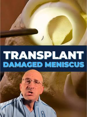 Meniscus Transplant: Complex Knee Pain Solution - Meniscal transplant surgery is an innovative procedure that replaces your damaged #meniscus with donor tissue, helping restore normal knee function and potentially delay arthritis development. Typically, the best candidates for #MeniscusTransplant include:    - Adults <50 with previous meniscectomy   - Persistent knee pain affecting daily activities   - Minimal joint arthritis   - Normal knee alignment   - Stable knee ligaments . Meniscal Replacement involves arthroscopic surgery where a size-matched donor meniscus is carefully positioned and secured in your knee. Recovery typically includes:   - Initial 6 wks of limited weight-bearing   - Structured physical therapy program   - Gradual return to activities over 6-12 mos   - Full sports return possible at 9-12 mos This surgery requires careful patient selection and commitment to rehabilitation. While not a permanent solution, it can provide significant relief for the right candidates. Key Benefits include Pain relief, Improved knee function, Potential delay of arthritis and Long-term joint preservation. Success rates show 85-90% patient satisfaction at 5 yrs, though results vary based on individual factors. Early intervention typically yields better outcomes. Complications are rare but may include:   - Graft failure (10-15%)   - Infection (<1%)   - Limited motion or Continued pain #meniscussurgery #meniscustransplant  . 👇 SHARE your Meniscus Injury story & experience #OrthopedicSurgery 