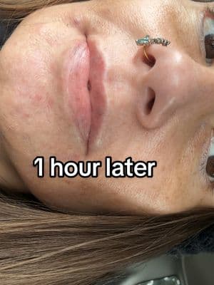 Replying to @kimkay0704 (TW lip filler/injection) The topical numbing worked great but still can feel tiny pokes. Feels like I got stung by a few bees but just like dental work it feels worse the first day & much better by the next. The filler itself has lidocaine in it so has a numbing effect. Only soreness the next day for me is where I have some bruising but it’s nothing major🥰 #lipfillervlog #lipfillerquestions #firstlipfiller #buffalony #injections #lipsbeforeandafter 