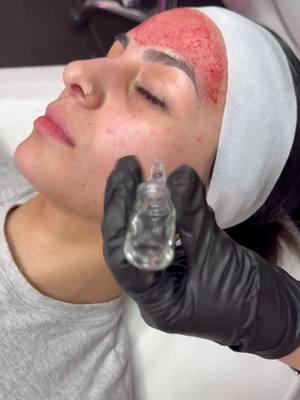 Hyaluronic Acid Microneedling 🎀🎀 #healthyskin #lips #microneeding #skinrejuvenation #chemicalpeels #acnetreatment #mesotherapy #facialtreatment #skincaretips #spa #injectables #healthyskin #aesthetic #lashes #lashlift #acnescars #makeup #microneedlingtherapy #skinpen #ipl #collagen #dysport #dermaplane #waxing #lipfillers #radiofrequency #morpheus #permanentmakeup #brows #microneedlingtreatment