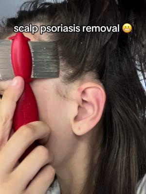 such braverism!! #psoriasis #scalppsoriasis #psoriasisremoval #satisfyingremoval #Psoriasispatches #scalppsoriasisremoval #psoriasisawareness #psoriasismanagement #psoriasiscommunity #psoriasistreatment #psoriasishelp #psoriasistok #dandruff #dandruffremoval #scalppsoriasisrelief #fyp #foryou #viral #psoriasissatisfying  