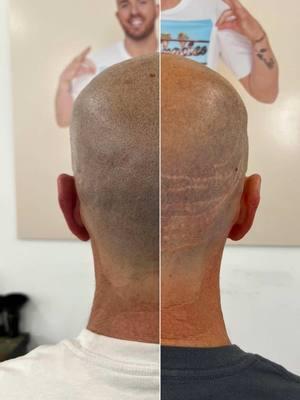 Life-changing scar coverup 🙏 This client received multiple failed hair transplants which resulted in major scaring on the back of his head. Our practitioner Derek Bogner did an absolutely incredible job covering up these scars and blending into his balding areas. #hairtattoo #scalptattoo #fyp #scalpmicropigmentation #hairloss #scalpmicrousa #scar #scarfix #hairtransplant #hairtransplantturkey #hairtransplantsurgery 