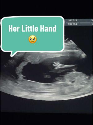 Our sweet girl 🎀 Her little hand 🥹💗 #babygirl #ultrasound #15weekspregnant #genderreveal #sweetbabygirl 