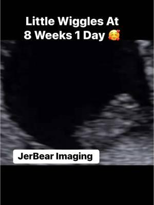 See Those Little Wiggles? 🥰  #jerbearimaging #8weeks1day #firsttrimester #peaceofmind #wiggles #fyp #imagingcenter #ultrasoundnearme #brownwood #momtobe #dadtobe #specialmomentsinlife www.jerbearimaging.com