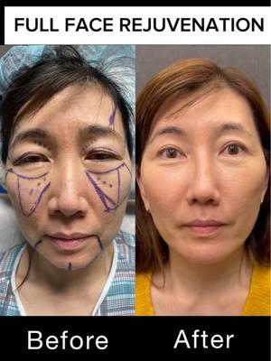 This beautiful patient wanted a natural, refreshed look, and we achieved just that! ✨Here’s what we did: Brow Lift for a more awake look, Upper Blepharoplasty to lift those eyes, Facelift for smoother, tighter skin, Fat Transfer for natural volume in the cheeks & under eyes and Chin Augmentation for a balanced profile Her results? A youthful, radiant version of herself—even more stunning. 🙌 #FacialRejuvenation #NaturalResults #GlowUp #BrowLift #Facelift #ChinAugmentation #DrRahban #beforeandafter #transformation #makeover #BeautyTransformation #FreshFace #beauty #goals #aesthetic #plasticsurgery #facelift #chinaugumentation 